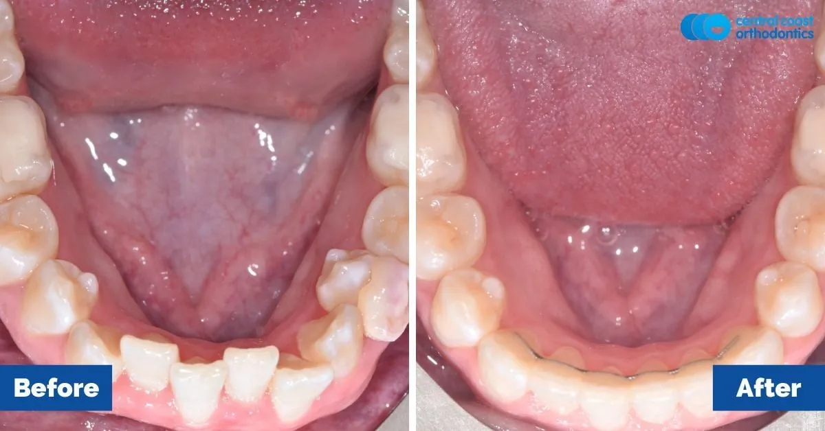 Before and after comparison, lower teeth viewed from above