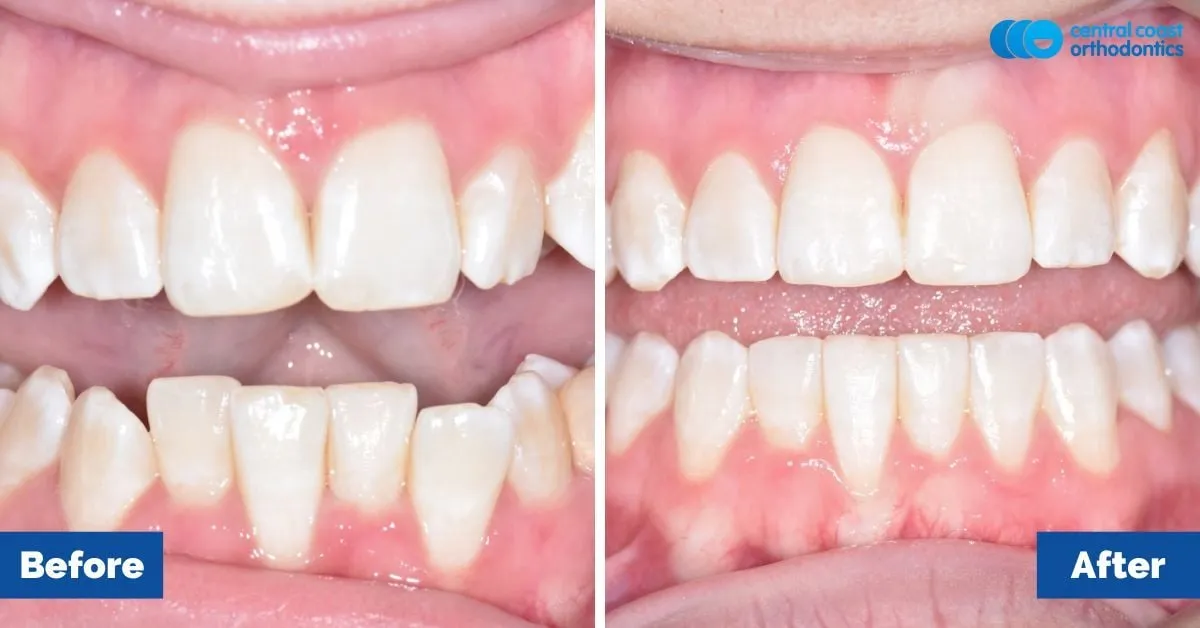 Before and after comparison, side view of the upper and lower teeth