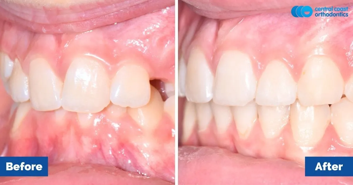Before and after comparison, side view of the upper and lower teeth
