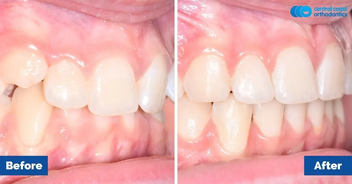 Before and after comparison, side view of the upper and lower teeth
