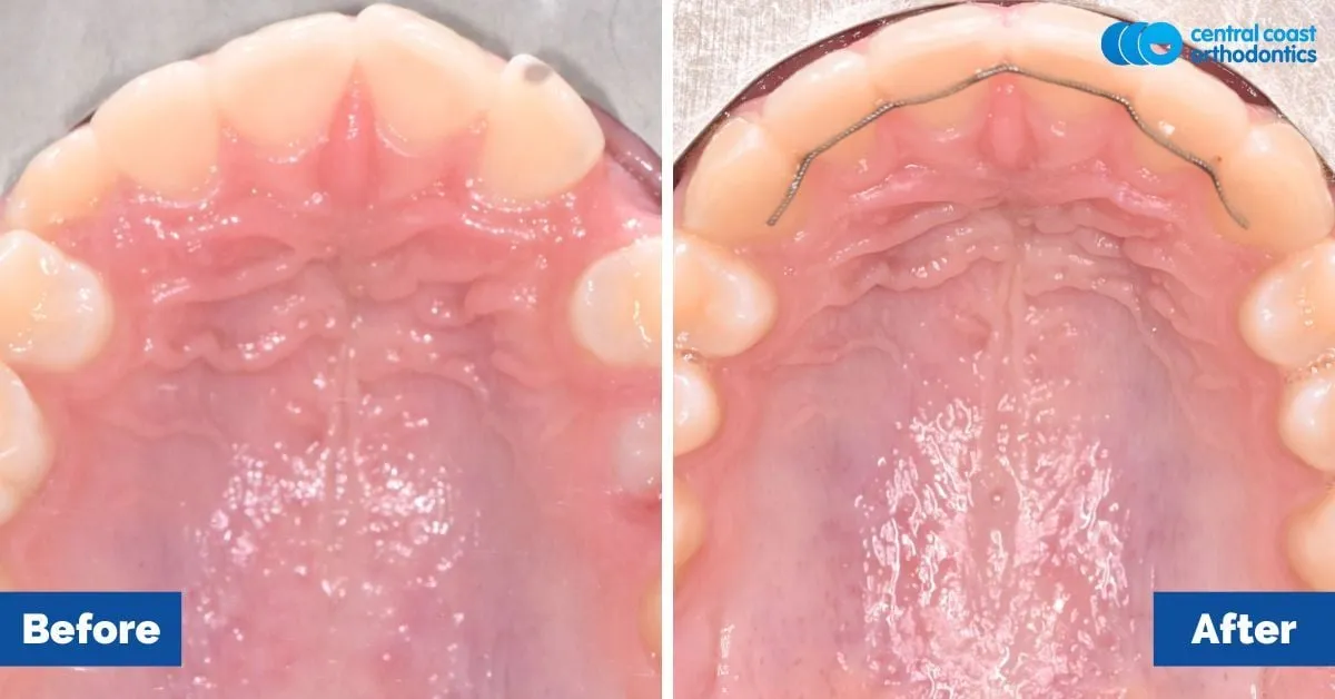 Before and after comparison, upper teeth viewed from below