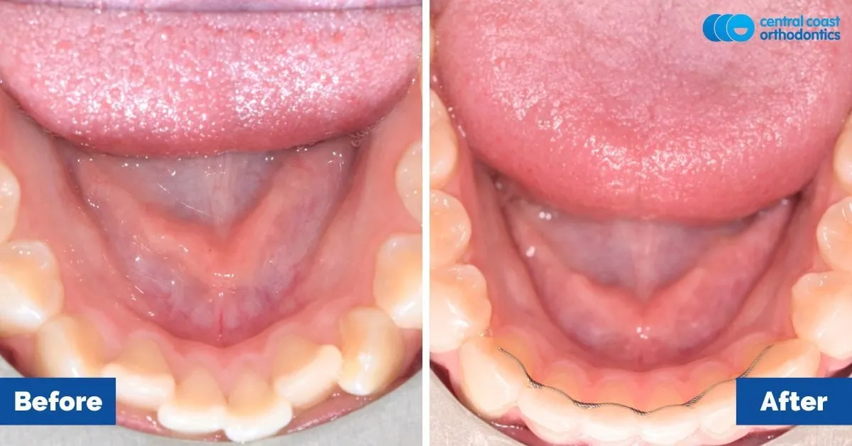 Before and after comparison, lower teeth viewed from above