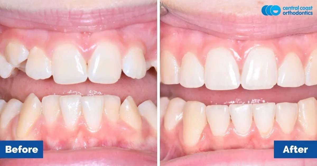 Before and after comparison, front view of the upper and lower teeth