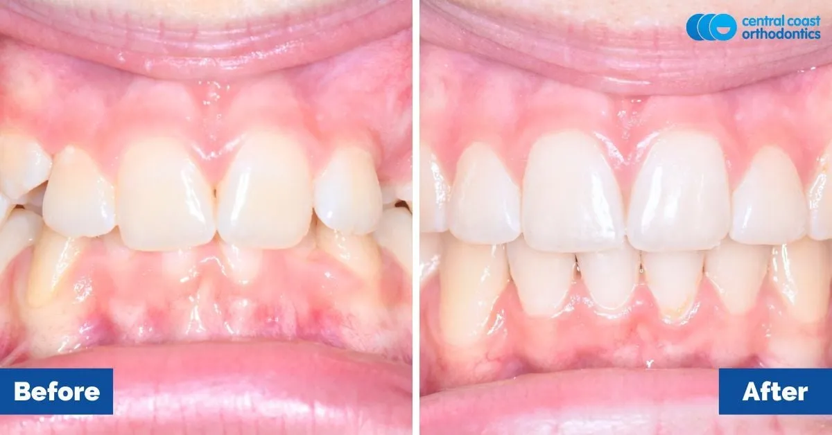 Before and after comparison, front view of the upper and lower teeth