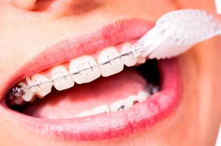 Close-up of a toothbrush cleaning teeth fitted with braces