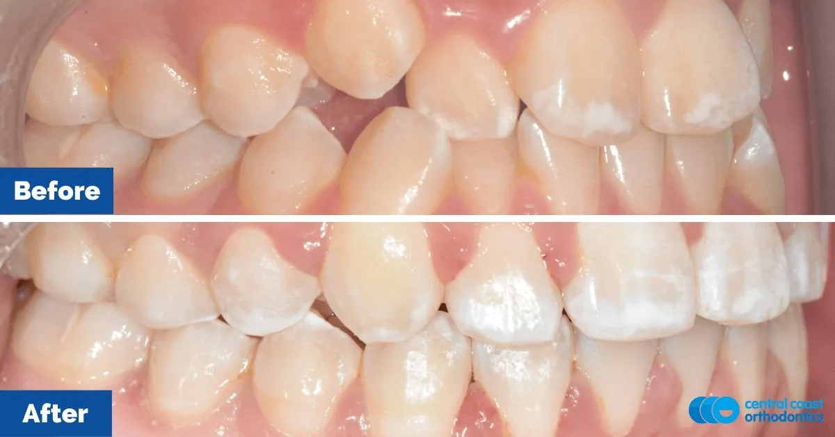 Before and after comparison, side view of the upper and lower teeth