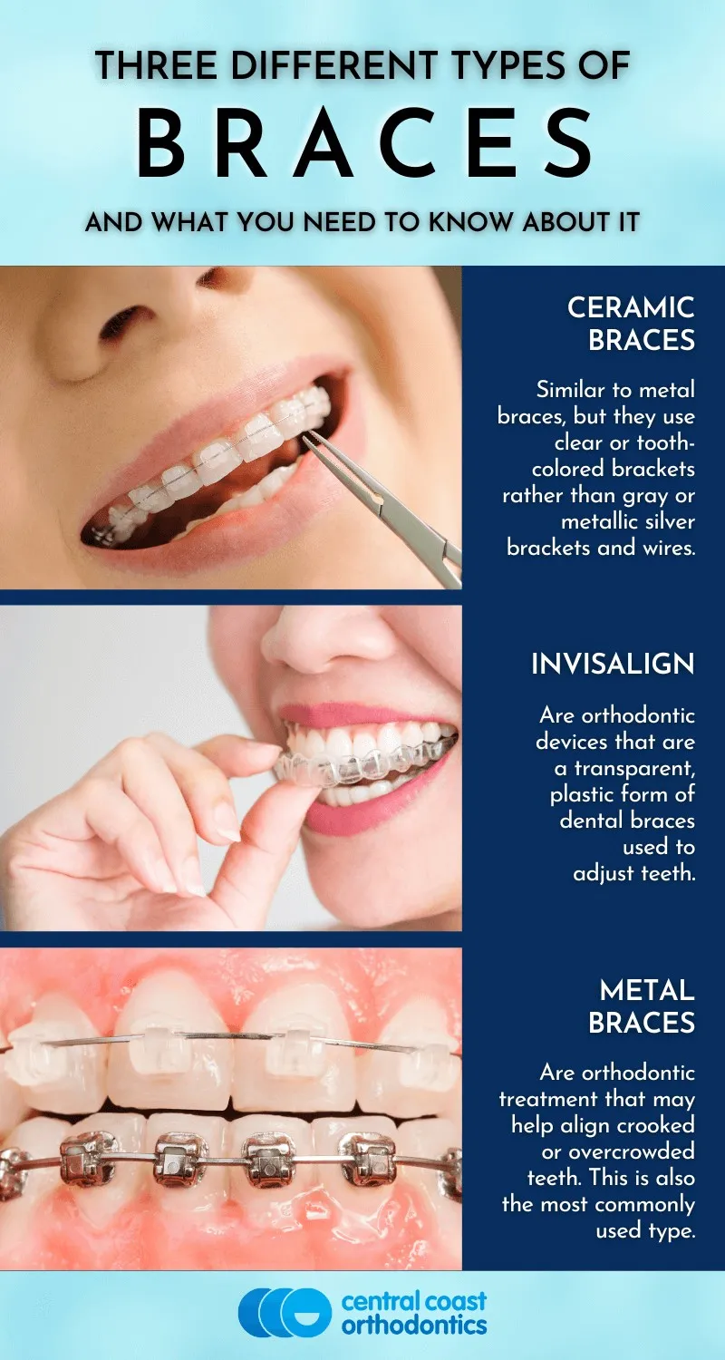 Three Types of Braces Erina