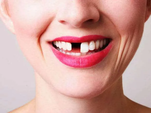 Woman smiling with a missing upper front tooth