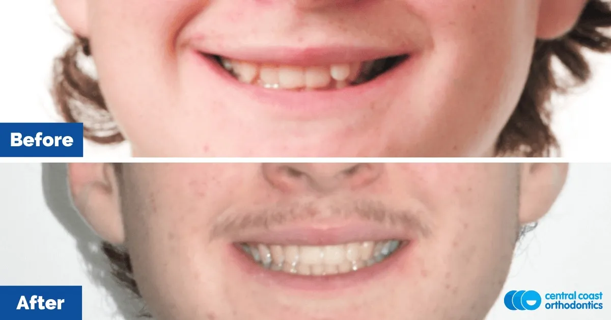 Before and after comparison of the patient's smile