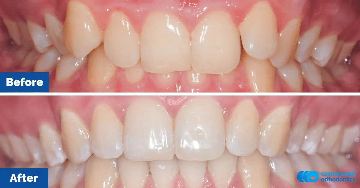 Before and after comparison, front view of the upper and lower teeth