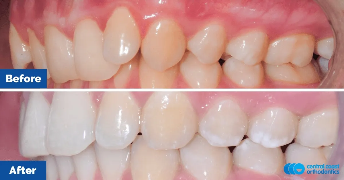 Before and after comparison, side view of the upper and lower teeth