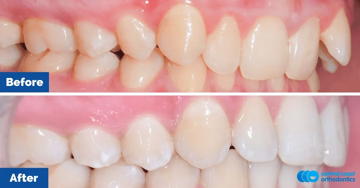 Before and after comparison, side view of the upper and lower teeth