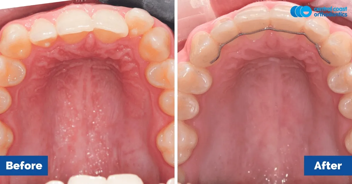 Before and after comparison, upper teeth viewed from below