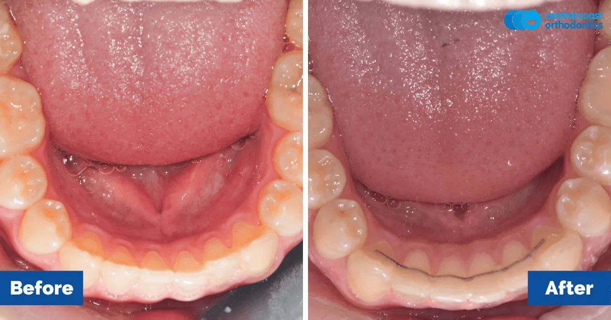 Before and after comparison, lower teeth viewed from above