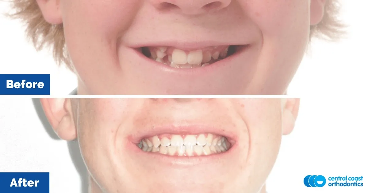 Before and after comparison of the patient's smile