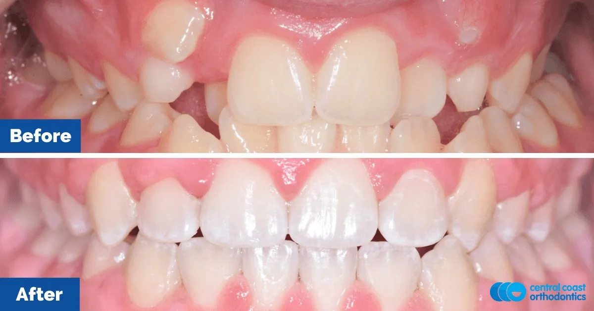 Before and after comparison, front view of the upper and lower teeth