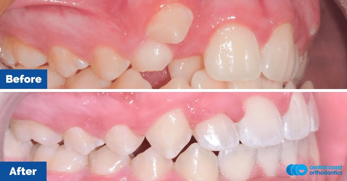Before and after comparison, side view of the upper and lower teeth