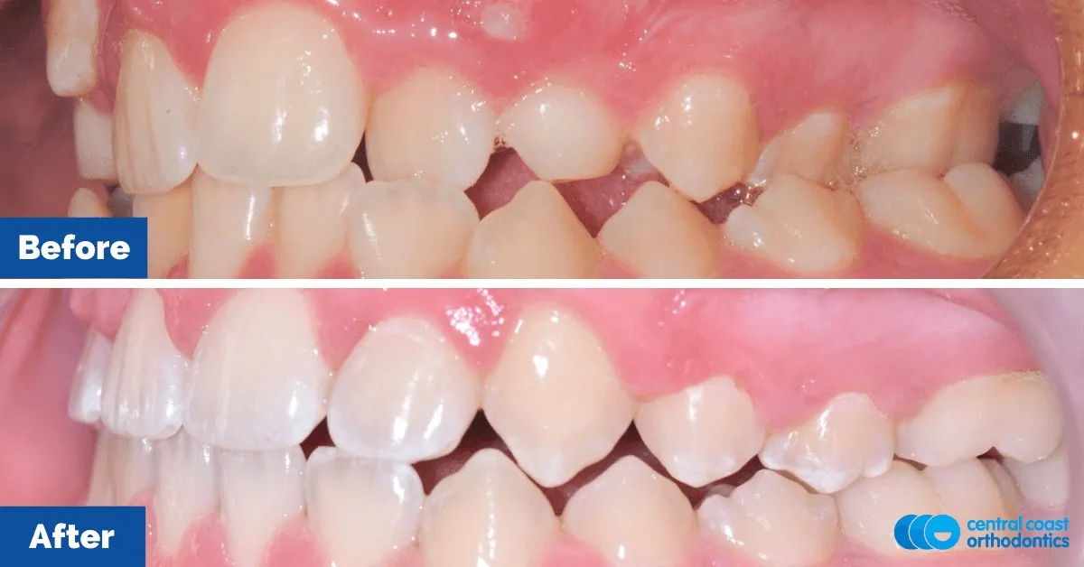 Before and after comparison, side view of the upper and lower teeth