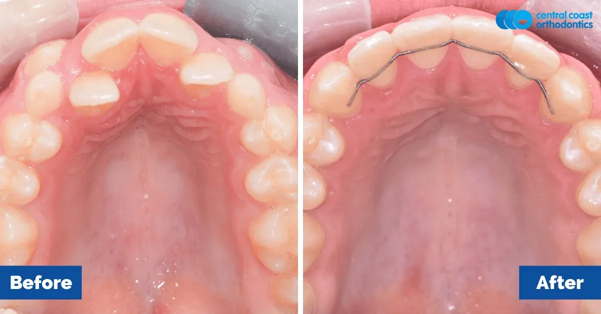 Before and after comparison, upper teeth viewed from below