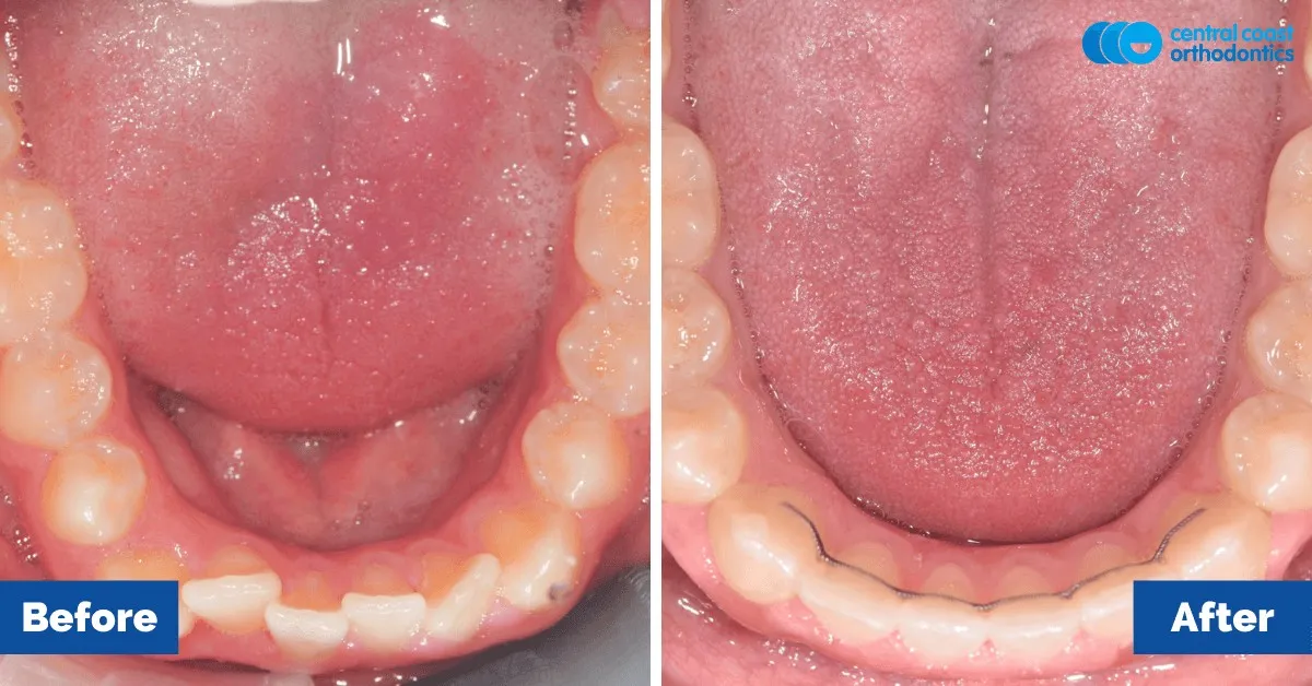 Before and after comparison, lower teeth viewed from above