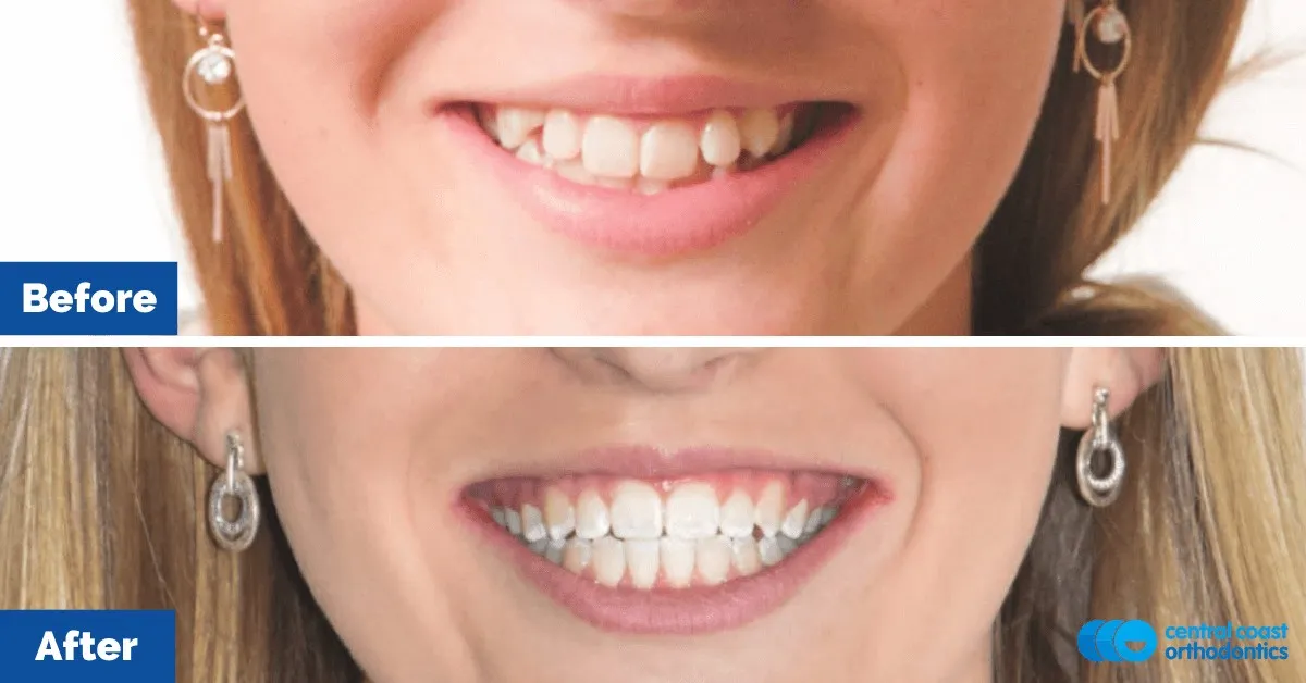 Before and after comparison of the patient's smile