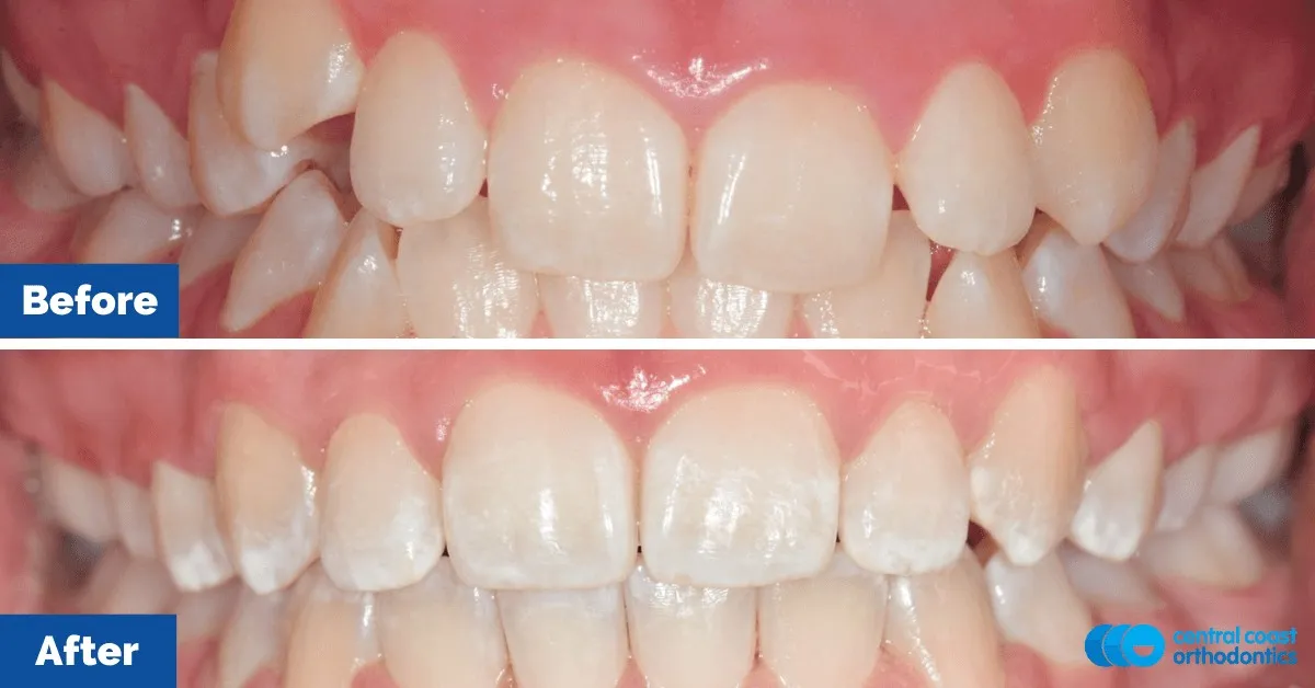 Before and after comparison, front view of the upper and lower teeth