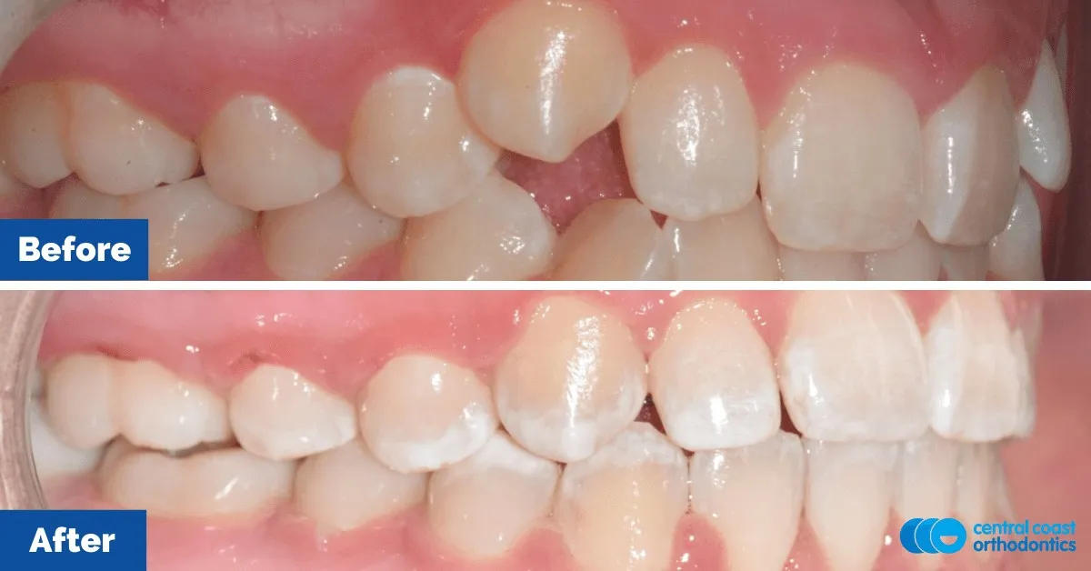 Before and after comparison, side view of the upper and lower teeth