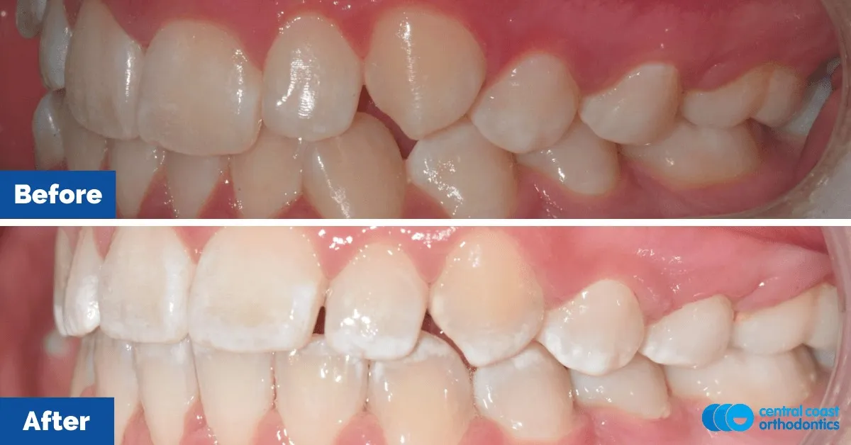 Before and after comparison, side view of the upper and lower teeth