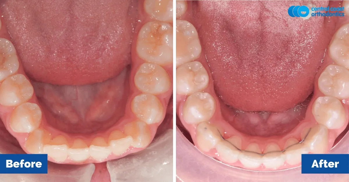 Before and after comparison, lower teeth viewed from above