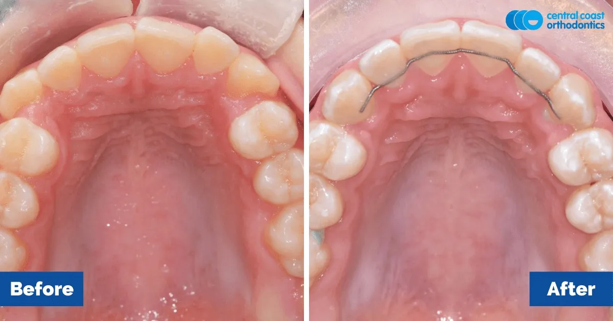 Before and after comparison, upper teeth viewed from below