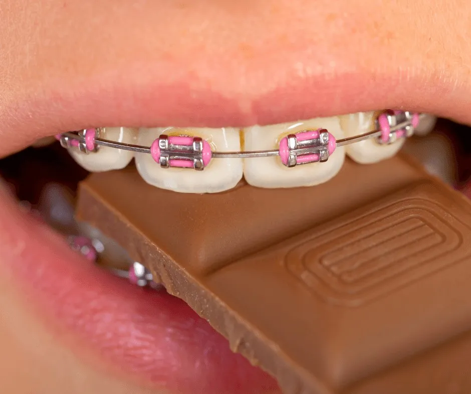 Close-up of teeth with pink-elastic braces biting into a block of chocolate