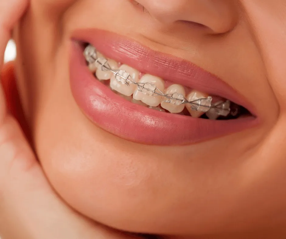 Close-up of a smile with ceramic braces and a fine archwire
