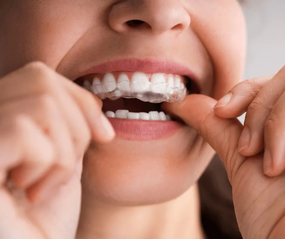 Close-up of a person fitting a clear aligner over their upper teeth