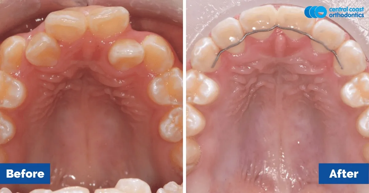 Before and after comparison, upper teeth viewed from below