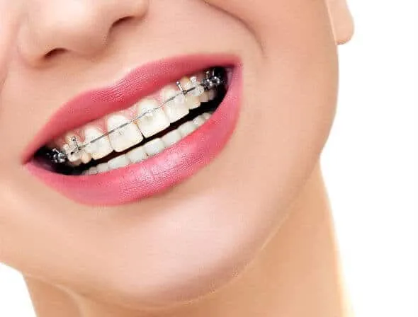 Close-up of a smile with metal braces on the upper and lower teeth