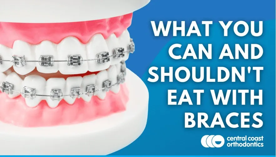 Banner reading What You Can and Shouldn't Eat With Braces, over a model of teeth with braces
