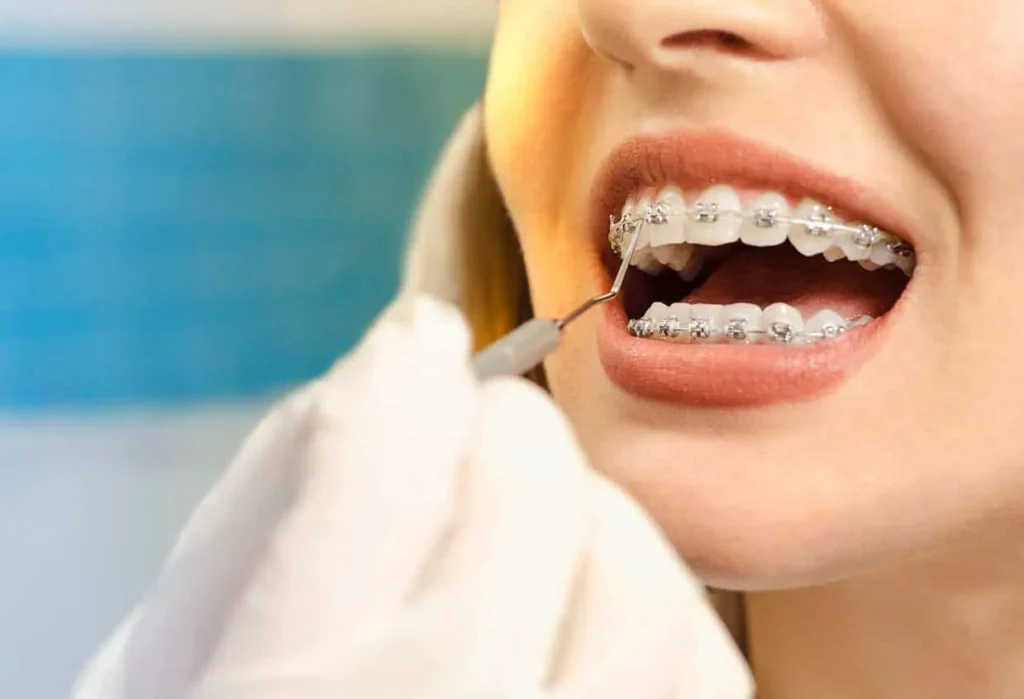Gloved hand adjusting the archwire on a patient's upper braces