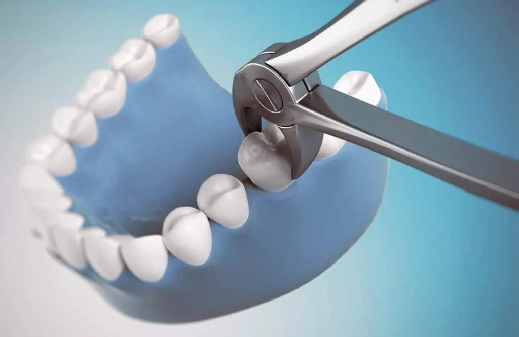Illustration of dental forceps gripping a tooth in a model of the lower jaw