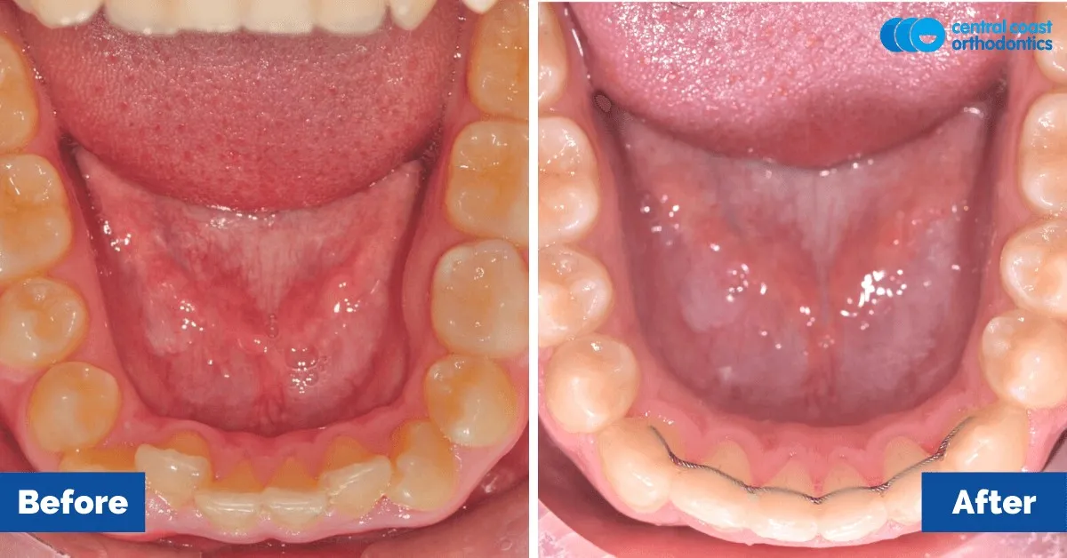 Before and after comparison, lower teeth viewed from above
