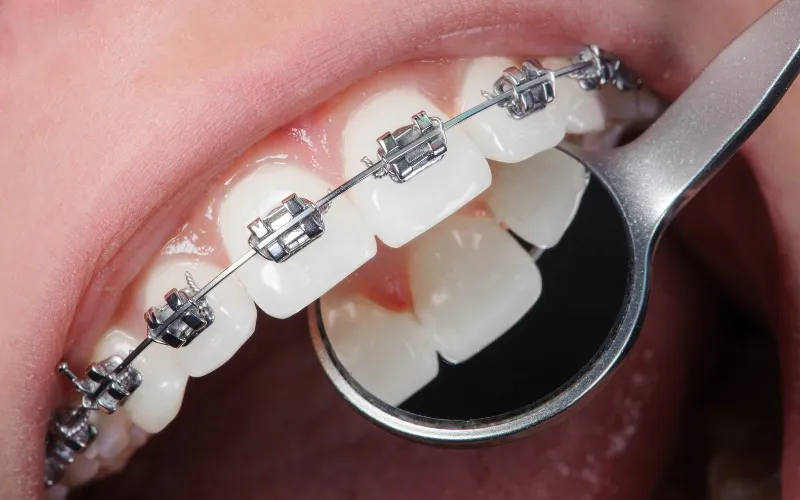 Dental mirror held against teeth fitted with braces