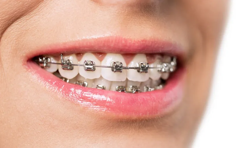Close-up of a smile with metal braces on the upper and lower teeth