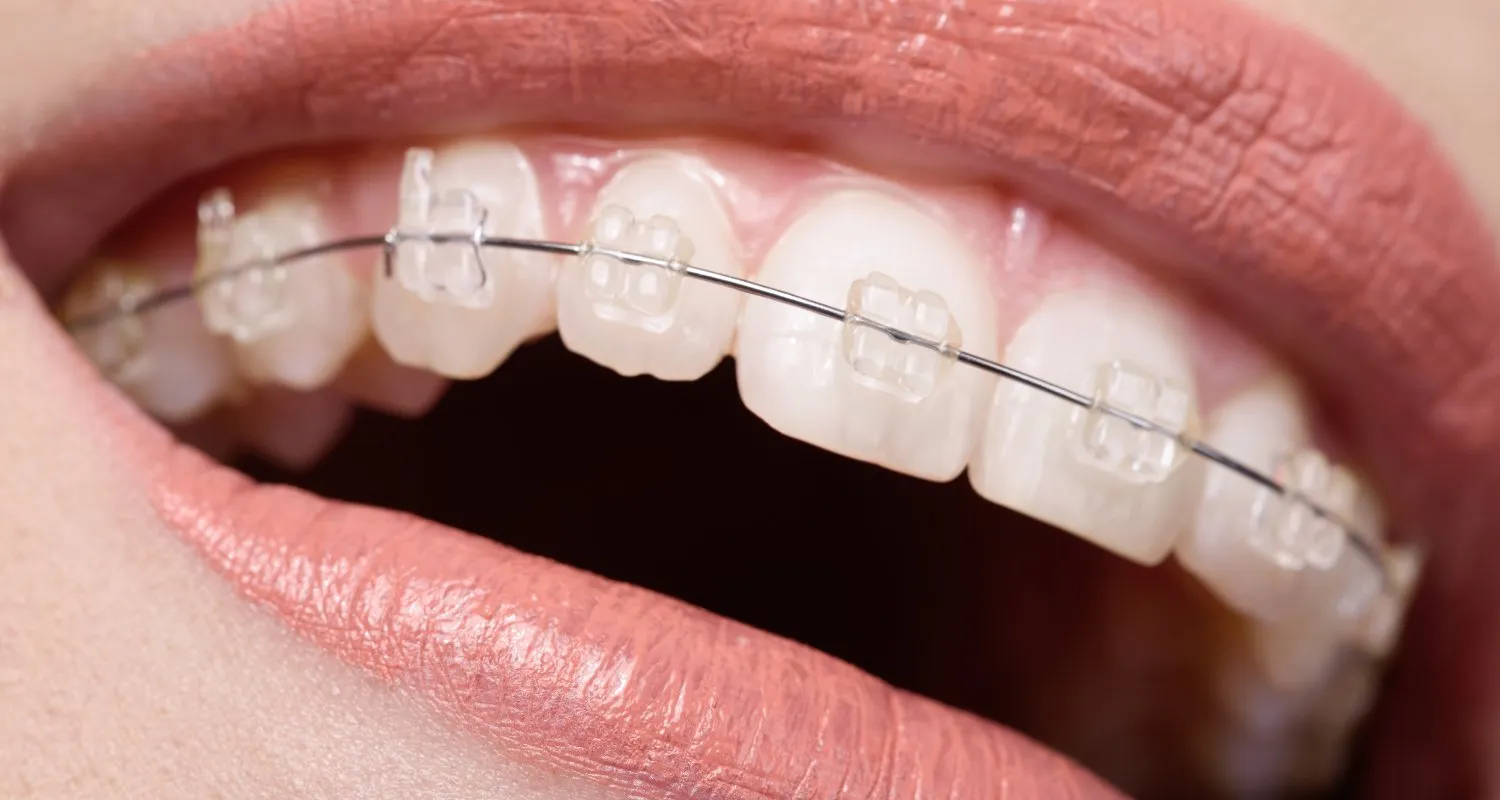 Close-up of a smile wearing clear ceramic braces