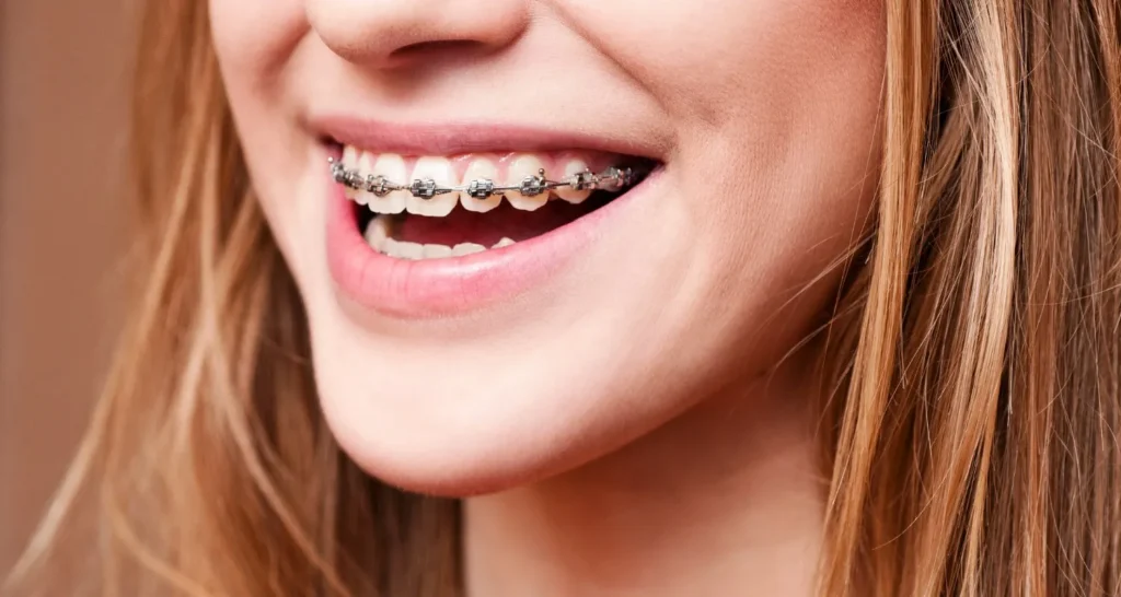 Close-up of a young woman smiling with metal braces