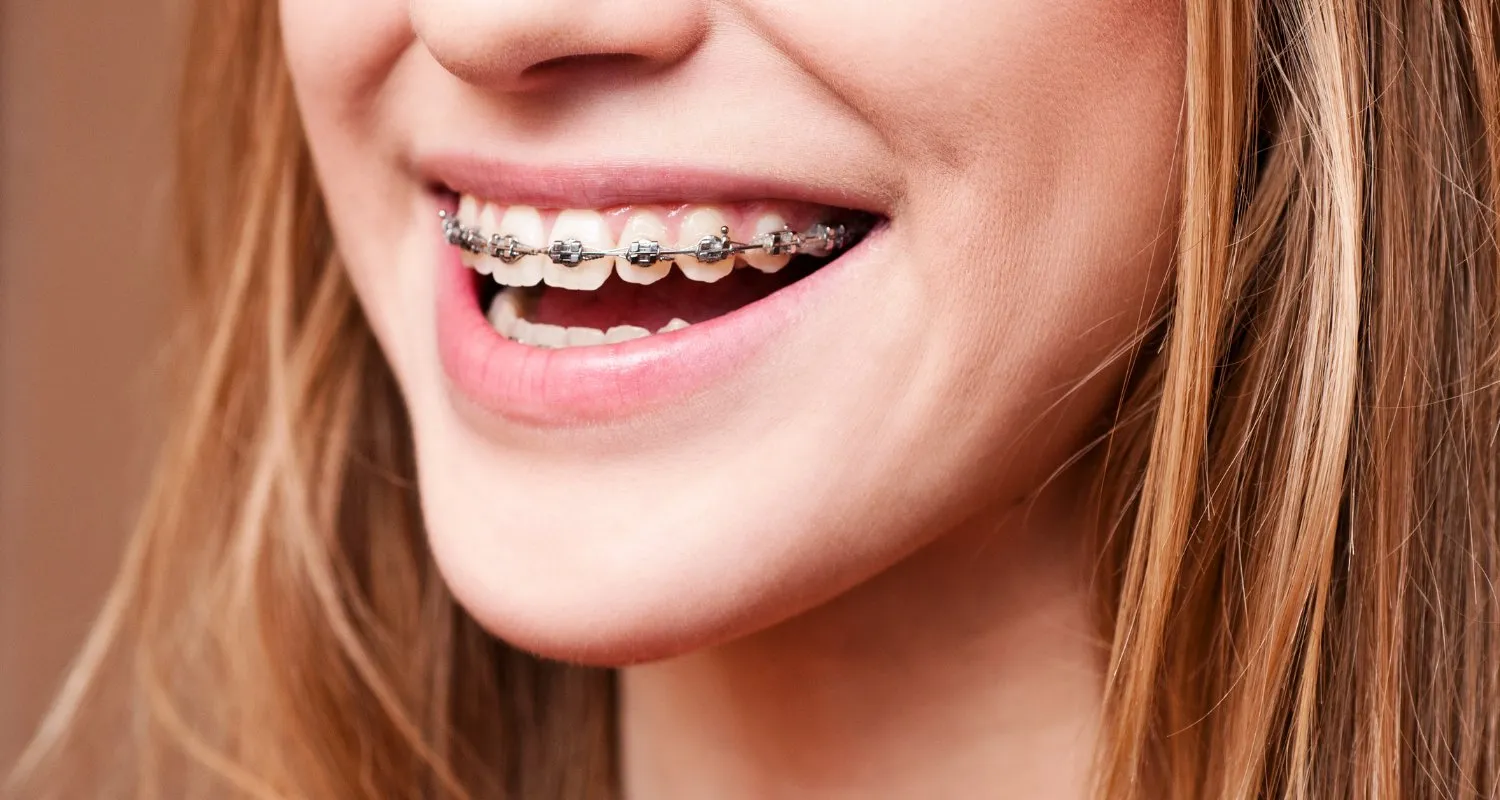 Close-up of a young woman smiling with metal braces