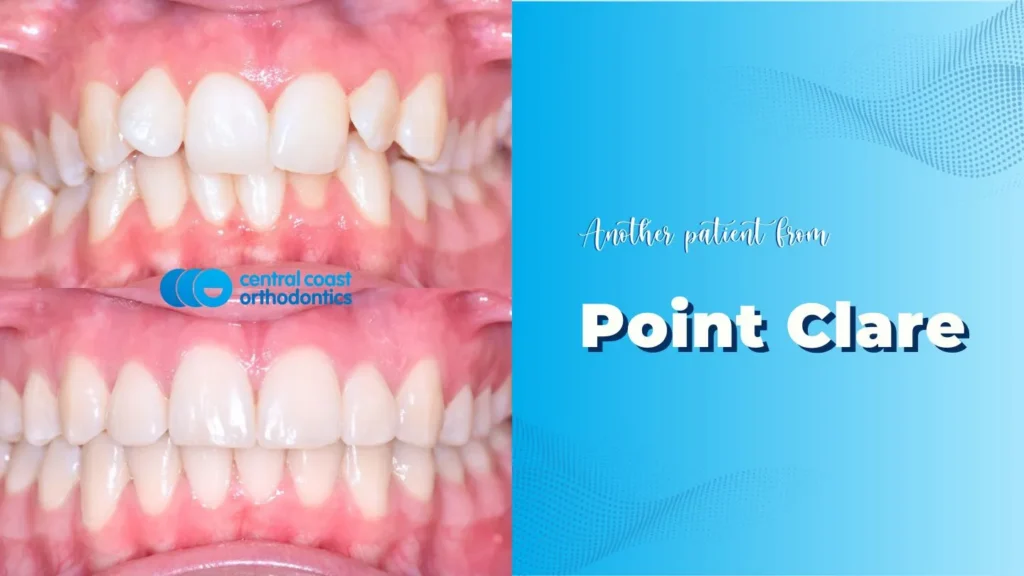 Before and after photographs of a Central Coast Orthodontics patient's teeth, labelled Point Clare