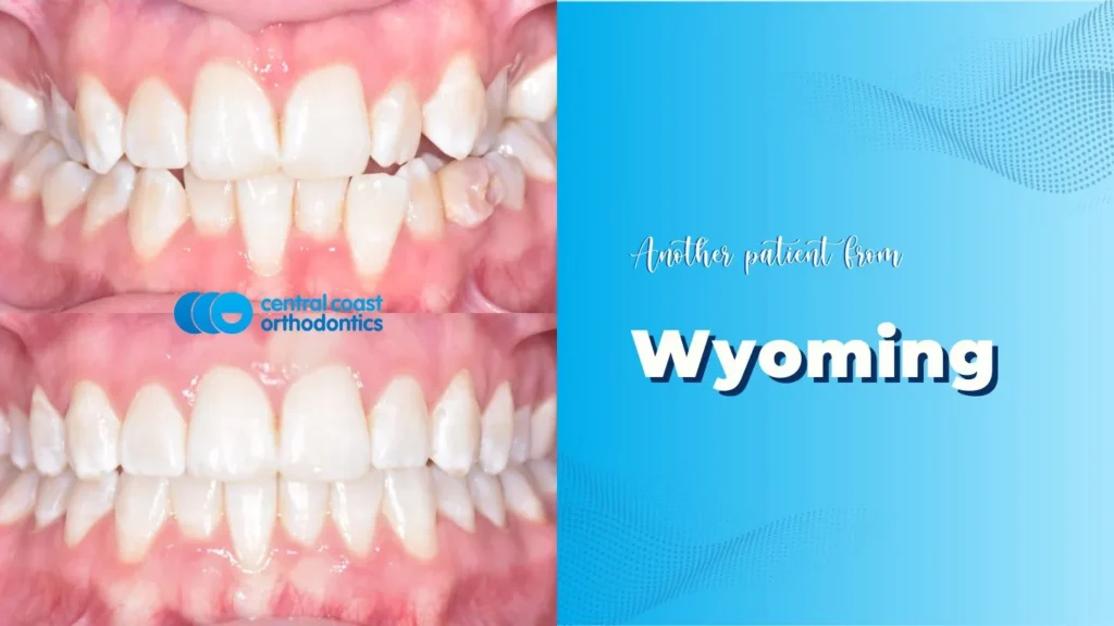 Before and after photographs of a Central Coast Orthodontics patient's teeth, labelled Wyoming