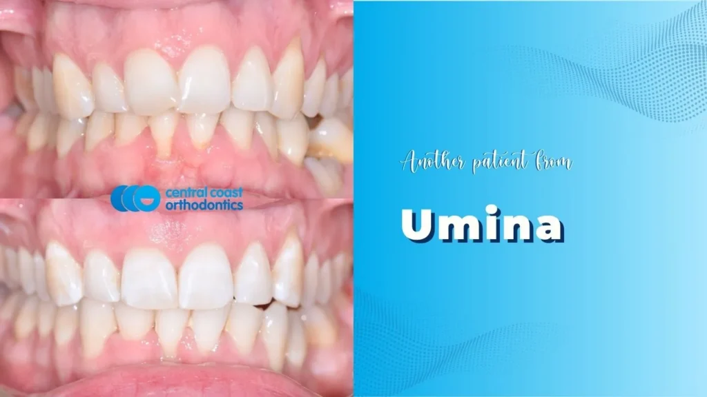 Before and after photographs of a Central Coast Orthodontics patient's teeth, labelled Umina