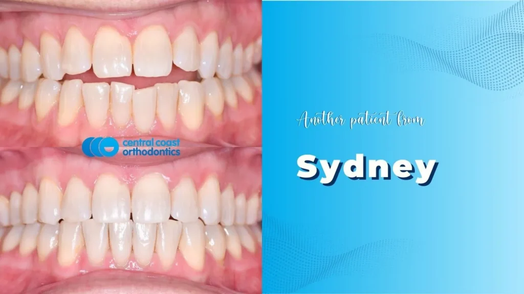 Before and after photographs of a Central Coast Orthodontics patient's teeth, labelled Sydney
