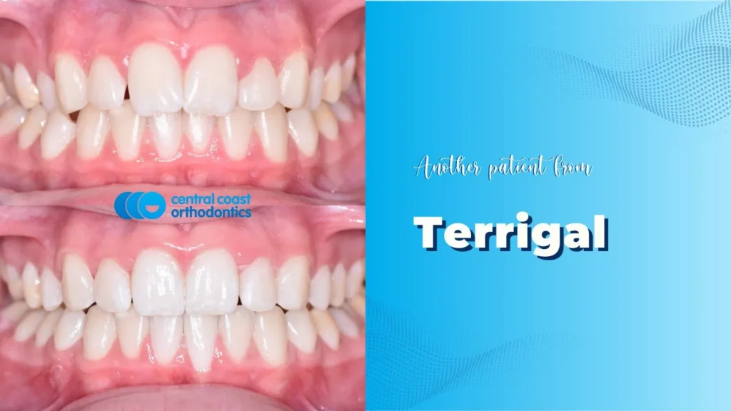 Before and after photographs of a Central Coast Orthodontics patient's teeth, labelled Terrigal