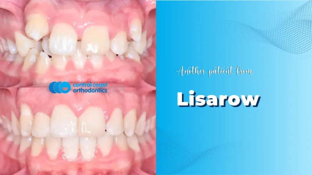 Before and after photographs of a Central Coast Orthodontics patient's teeth, labelled Lisarow